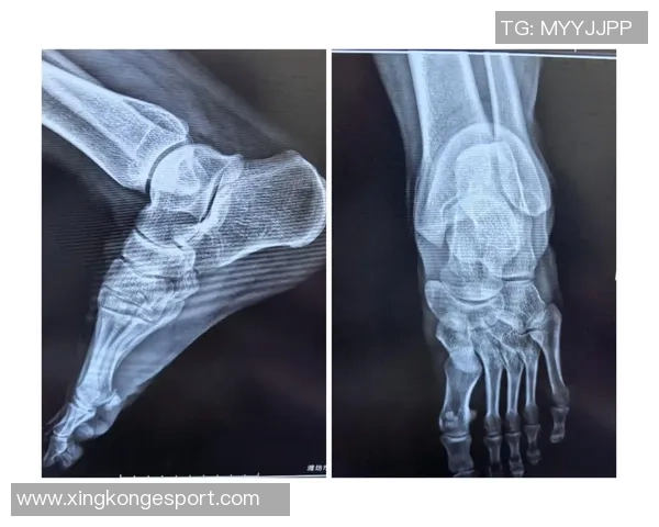 猛龙主帅透露博伊尔斯拇指受伤严重X光检查结果显示无骨折 猛龙主帅透露博伊尔斯拇指受伤严重X光检查结果显示无骨折